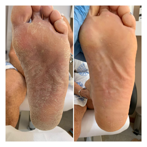 Il prima e dopo il trattamento innovativo yumi feet per i piedi a base di acido lattico! Addio pelle secca, calli indesiderati e spacchi nei talloni! Tutto ciò senza l’utilizzo delle lame!